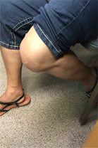 Subvastus Minimally Invasive Knee Replacement