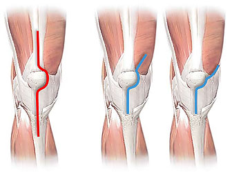 Subvastus Minimally Invasive Knee Replacement