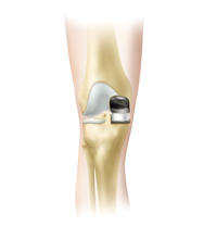 Subvastus Unicompartmental Knee Resurfacing