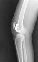 Subvastus Unicompartmental Knee Resurfacing